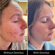 Load image into Gallery viewer, Omnilux Clear LED Flexible Light Therapy Mask with proven results.