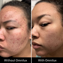 Load image into Gallery viewer, Omnilux Clear LED Flexible Light Therapy Mask with proven results.