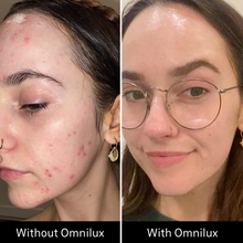 Load image into Gallery viewer, Omnilux Clear LED Flexible Light Therapy Mask with proven results.