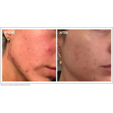 Load image into Gallery viewer, Glowbiotics Probiotic Acne Treatment Cleanser 5oz - European Beauty by B